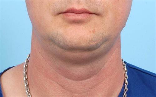 Submental Liposuction Before Photo | Miami, FL | Baker Plastic Surgery